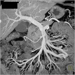 Patent PV/SMV - CTisus CT Scan