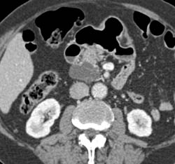 Intraductal Papillary Mucinous Neoplasm (IPMN) - CTisus CT Scan