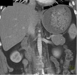 Cystadenoma - CTisus CT Scan