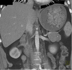 Cystadenoma - CTisus CT Scan