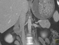 Cystadenoma - CTisus CT Scan