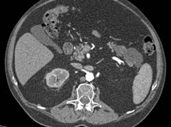 Cystadenoma - CTisus CT Scan