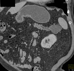 Cystadenoma - CTisus CT Scan