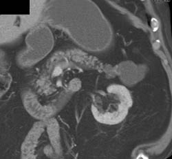 Cystadenoma - CTisus CT Scan