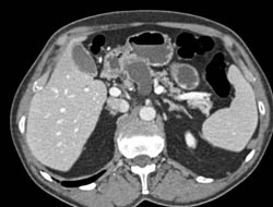 Intraductal Papillary Mucinous Neoplasm (IPMN) - CTisus CT Scan