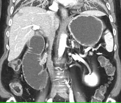 Pancreatic Cancer Obstructs Duodenum at Level of Ligament of Trietz - CTisus CT Scan