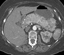 Islet Cell Tumor Involves the Entire Pancreas - CTisus CT Scan