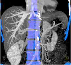 Pancreatic Cancer Encases the SMA and Left Renal Artery and Portal Vein/SMV - CTisus CT Scan