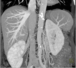 Dilated Gonadal Vein Due to Renal Artery Encasement - CTisus CT Scan