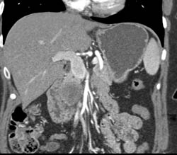 Pancreatic Cancer - CTisus CT Scan