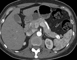 Splenic Artery Aneurysm Simulates An Islet Cell Tumor - CTisus CT Scan