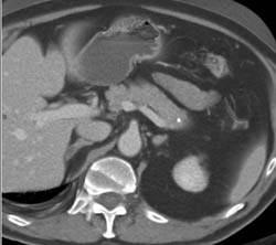 Atrophy Tail of the Pancreas - CTisus CT Scan