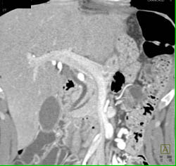 Nice Visualization of Common Bile Duct (CBD) of Pancreatic Duct - CTisus CT Scan