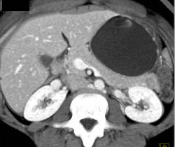 1 Cm Cancer in Tail of Pancreas - CTisus CT Scan