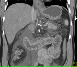 Acute Pancreatitis - CTisus CT Scan