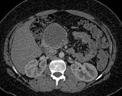 Pseudocyst - CTisus CT Scan