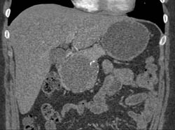 Pseudocyst - CTisus CT Scan