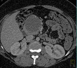 Pseudocyst - CTisus CT Scan