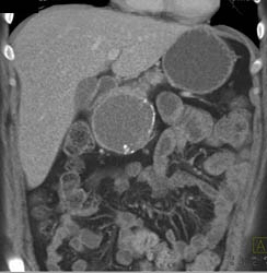 Pseudocyst - CTisus CT Scan