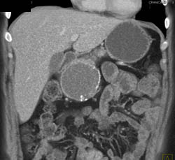 Pseudocyst - CTisus CT Scan