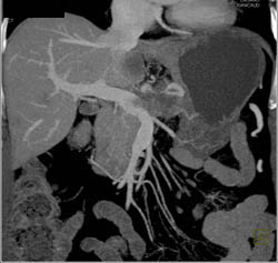 Pancreatic Cancer Includes the Superior Mesenteric Vein (SMV), Splenic Vein and Portal Vein - CTisus CT Scan