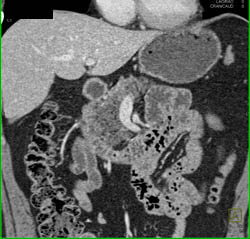 Pancreatic Cancer - CTisus CT Scan