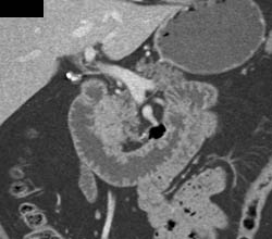 Pancreatic Cancer - CTisus CT Scan