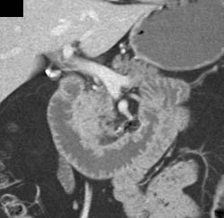 Pancreatic Cancer - CTisus CT Scan