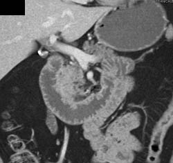 Pancreatic Cancer - CTisus CT Scan