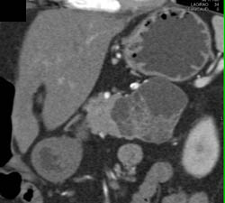 Cystadenoma Vs SPEN- Final Diagnosis Was SPEN - CTisus CT Scan