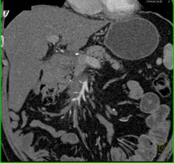 Pancreatic Cancer Encases the SMA/SMV - CTisus CT Scan