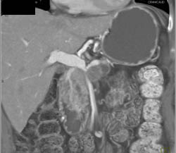 Encasement of PV/SMV By Pancreatic Cancer - CTisus CT Scan