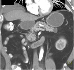 Intraductal Papillary Mucinous Neoplasm (IPMN) - CTisus CT Scan