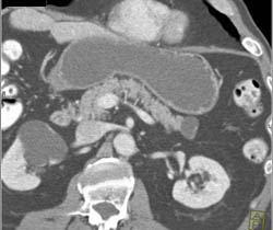 Intraductal Papillary Mucinous Neoplasm (IPMN) - CTisus CT Scan