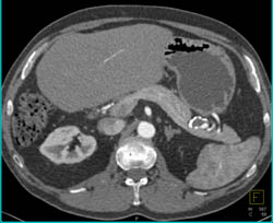 Splenic Artery Aneruysm - CTisus CT Scan