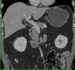 Distal Pancreatectomy - CTisus CT Scan