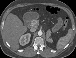 Islet Cell Tumor - CTisus CT Scan