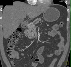 Islet Cell Tumor - CTisus CT Scan