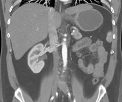 Islet Cell Tumor - CTisus CT Scan