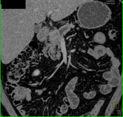 Islet Cell Tumor - CTisus CT Scan