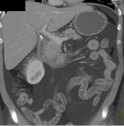 Islet Cell Tumor - CTisus CT Scan