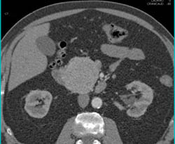 Islet Cell Tumor - CTisus CT Scan