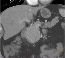 Islet Cell Tumor - CTisus CT Scan