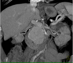 Islet Cell Tumor - CTisus CT Scan