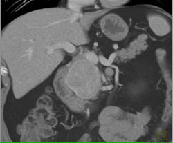 Islet Cell Tumor - CTisus CT Scan