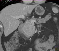 Islet Cell Tumor - CTisus CT Scan