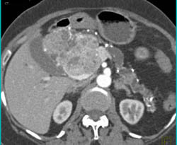 Islet Cell Tumor - CTisus CT Scan