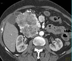 Islet Cell Tumor - CTisus CT Scan