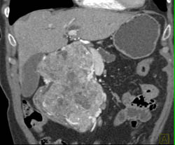 Islet Cell Tumor - CTisus CT Scan