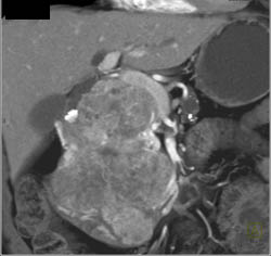 Islet Cell Tumor - CTisus CT Scan